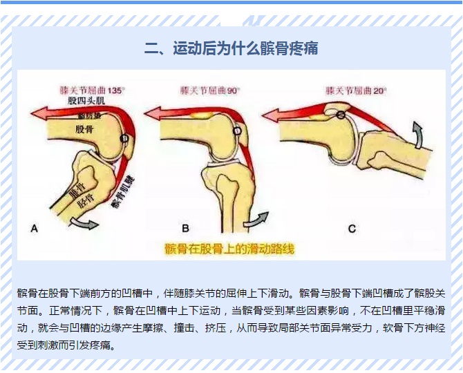 【健康】运动后髌骨疼痛怎么办?