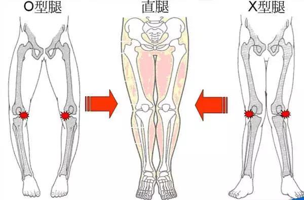 【健康】宝宝o型腿x型腿的"小秘密"(一)