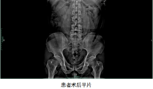 患者术后平片.png
