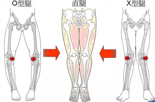 股骨内旋型o型腿图片