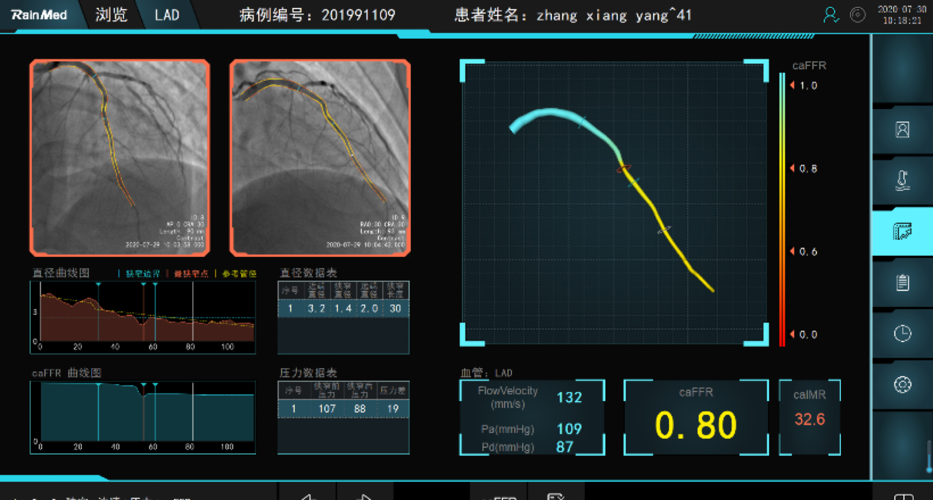 4,FlashAngio FFR System测量结果caFFR:8.0.jpg 4,FlashAngio FFR System测量结果caFFR:8.0.jpg