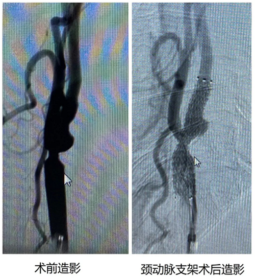 北京中医医院完成首例心脑联合介入手术.png 北京中医医院完成首例心脑联合介入手术.png