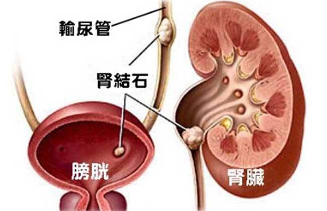 东直门医院东区泌尿外科完成一例输尿管软镜激光碎石手术"